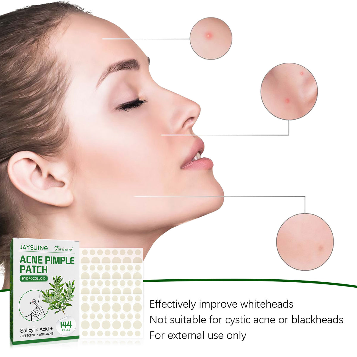 Hydrocolloid Pimple Patches