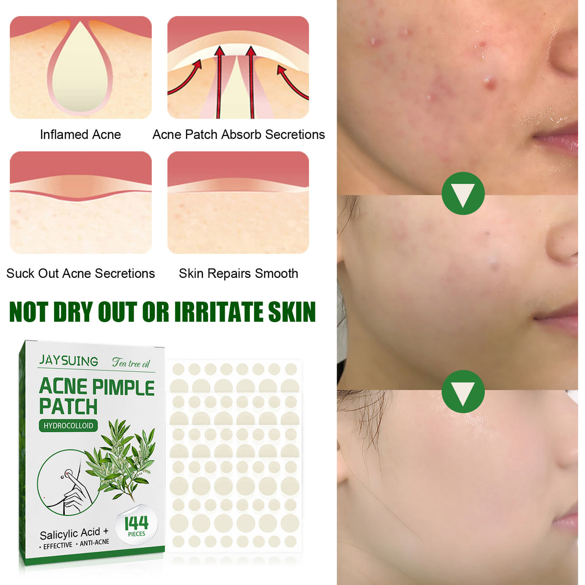 Hydrocolloid Pimple Patches